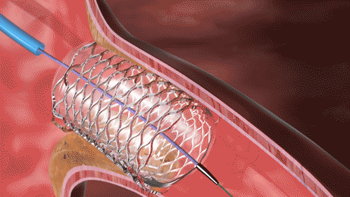 Detailed illustration of a coronary artery stent being placed to open a blocked vessel, demonstrating expertise of Dr. Swapnil Garde best cardiologist in Bhopal.