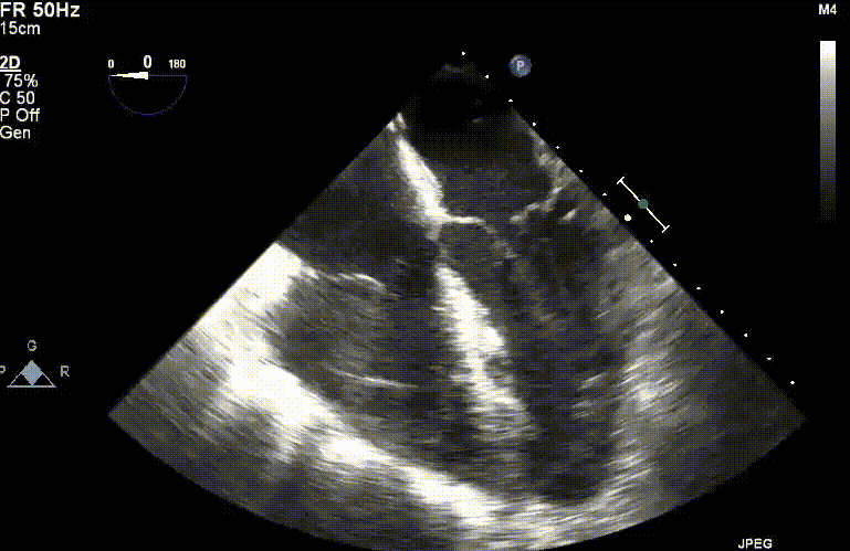 2D echocardiography (ECHO) showing a cross-sectional view of the heart, illustrating cardiac imaging by Dr. Swapnil Garde best cardiologist in Bhopal.