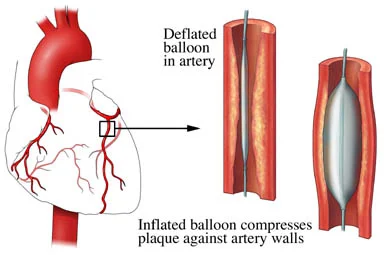 Step-by-step diagram of angioplasty in Bhopal showing placement of a balloon catheter inside a blocked artery, and the balloon inflating to compress plaque against artery walls.