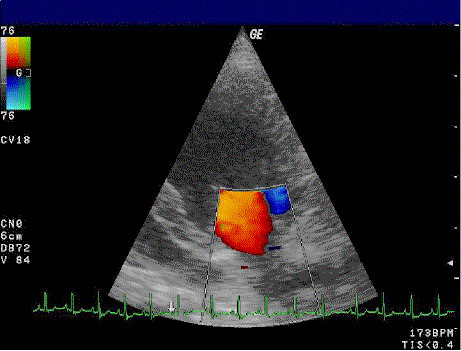 Color Doppler echocardiography test image showing blood flow velocities in the heart, with ECG trace, for Echocardiography Test in Bhopal.