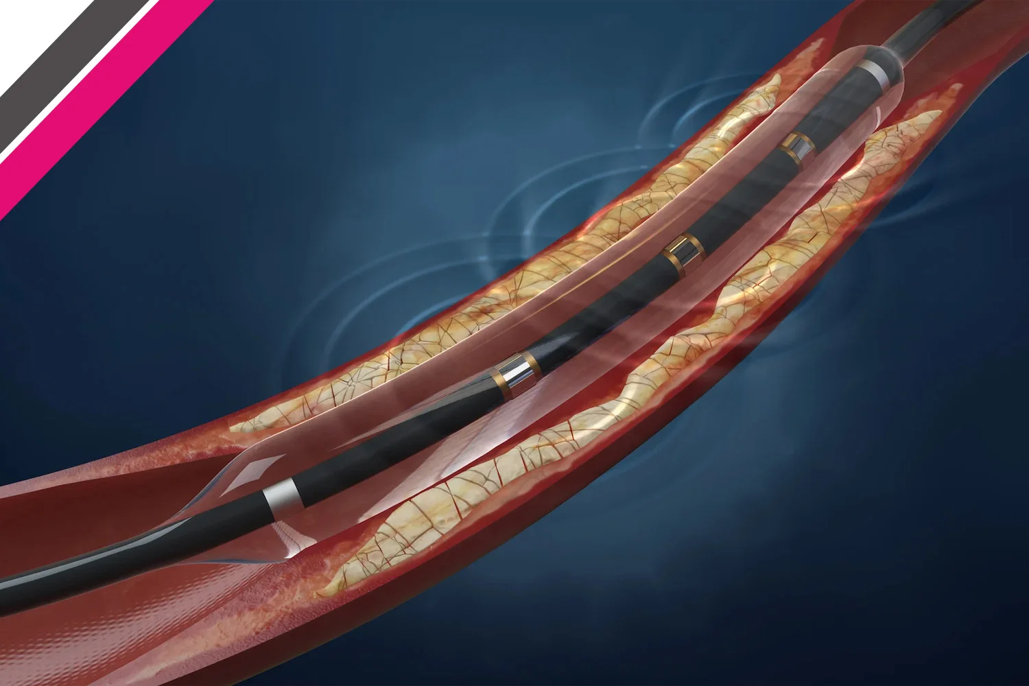 Close-up medical illustration showing balloon angioplasty procedure inside a narrowed artery, highlighting Angioplasty in Bhopal.