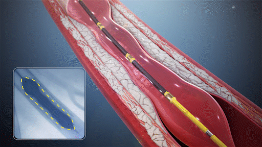 Medical illustration of balloon angioplasty inflating inside a narrowed artery, for Angioplasty in Bhopal.