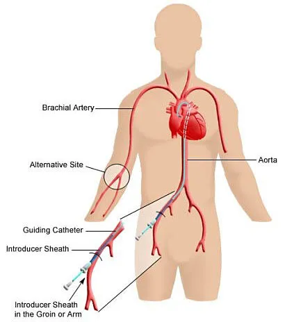 Diagram showing catheter path and arterial access sites for angiography in Bhopal, highlighting groin and arm approaches.