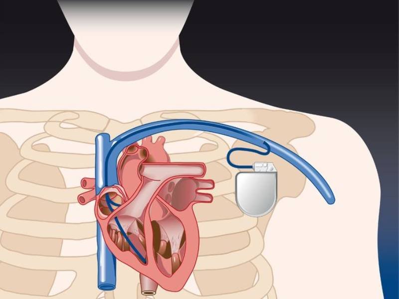 Medical illustration of pacemaker implantation in Bhopal showing device placement and leads inside the chest and heart.