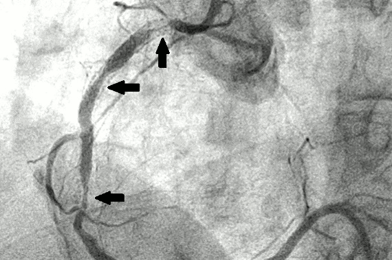 Coronary angiography X-ray image with arrows indicating blocked heart arteries, exemplifying expertise of Dr. Swapnil Garde best cardiologist in Bhopal in diagnosing coronary artery disease.
