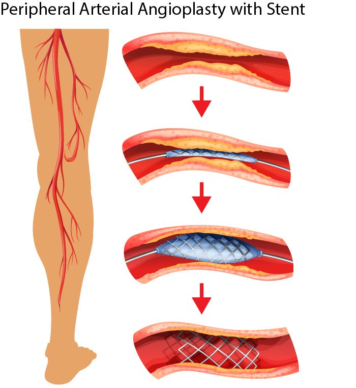 Stepwise diagram of Peripheral Angioplasty with stent in the leg artery, performed by Dr. Swapnil S Garde in Bhopal.