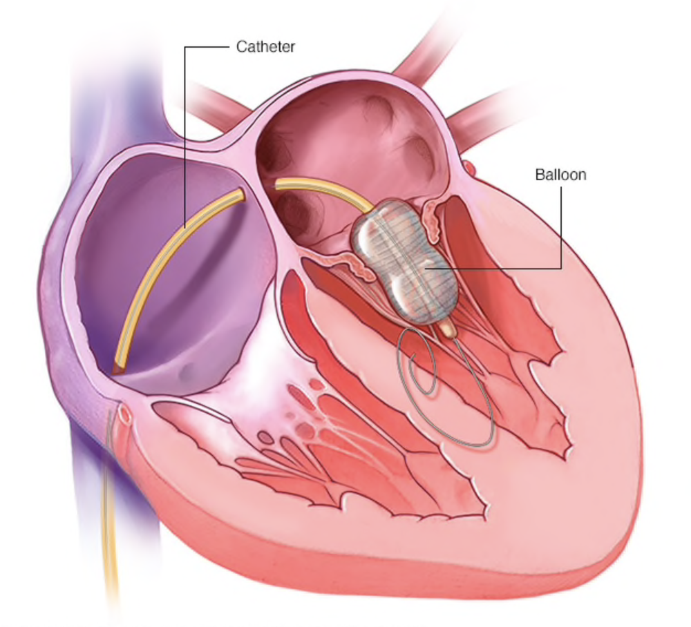 Medical illustration of Balloon Mitral Valvuloplasty performed by Dr. Swapnil S Garde, Interventional Cardiologist in Indore.