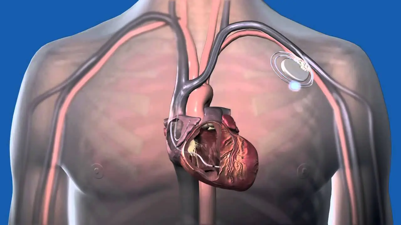Medical illustration showing a pacemaker with leads connected to the heart, demonstrating advanced cardiac care expertise by Dr. Swapnil Garde, best cardiologist in Bhopal.