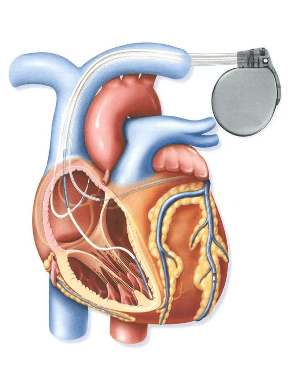 Medical illustration of a heart with pacemaker implantation performed by Dr. Swapnil S Garde in Bhopal.