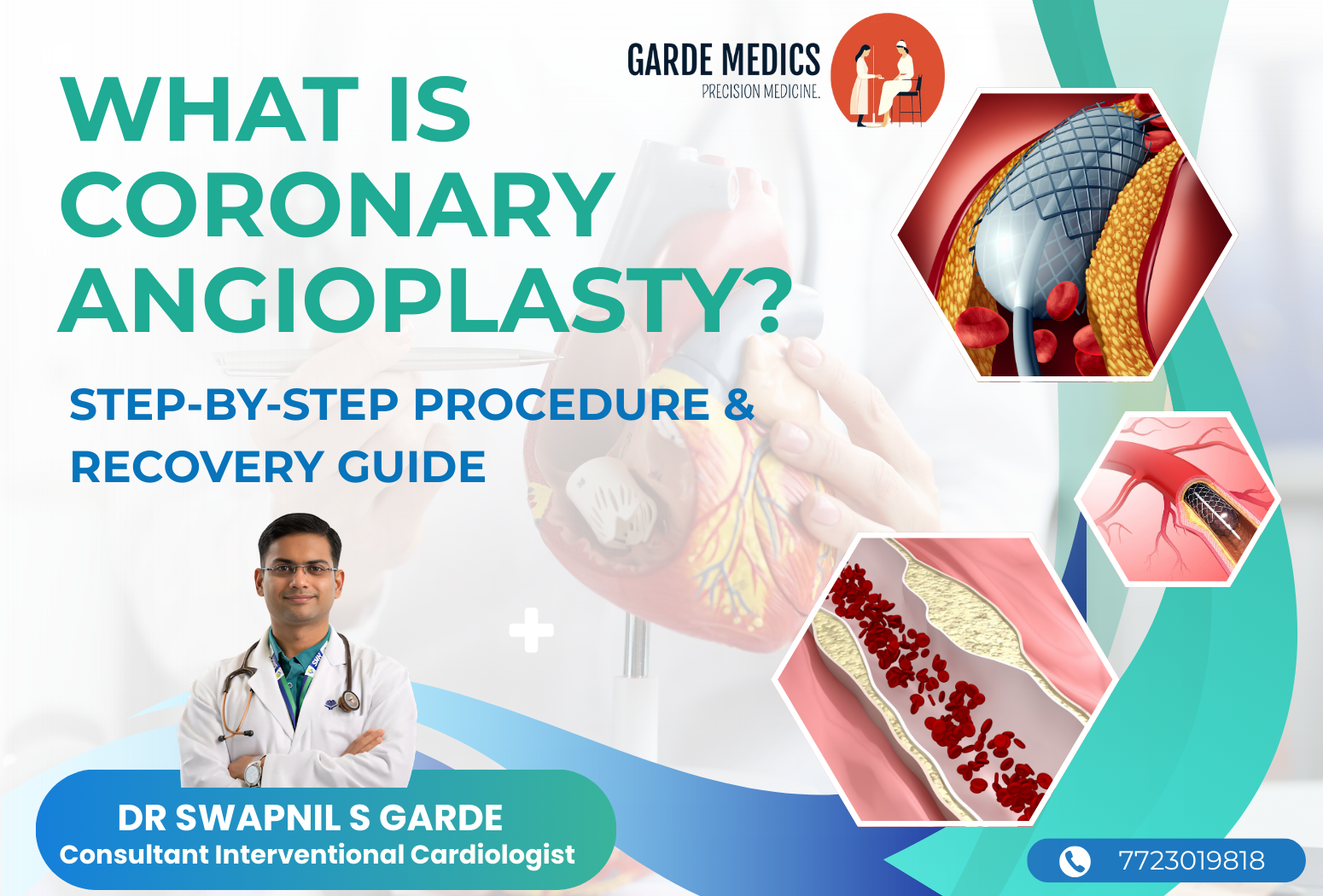 What is coronary angioplasty step-by-step procedure and recovery guide by Dr Swapnil S Garde cardiologist in Bhopal